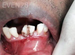 Luis-Herrera-Partial-Dentures-before-1