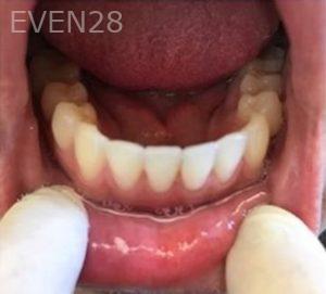 Maryam-Hadian-Invisalign-Clear-Aligners-after-3b
