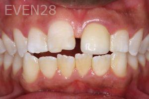 Michael-Fulbright-Orthodontic-Braces-before-1b