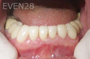 Michael-Shirvani-Dental-Crowns-after-1