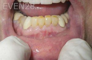 Michael-Shirvani-Dental-Crowns-before-1