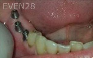Michael-Shirvani-Dental-Implants-after-1