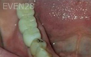 Michael-Shirvani-Dental-Implants-after-1b