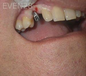 Michael-Shirvani-Dental-Implants-after-2