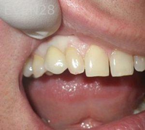 Michael-Shirvani-Dental-Implants-after-2b