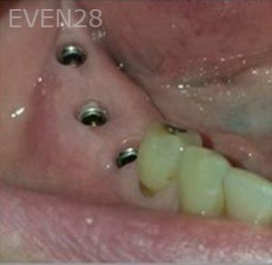 Michael-Shirvani-Dental-Implants-before-1