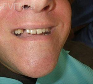 Michael-Shirvani-Dental-Implants-before-2