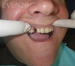 Michael-Shirvani-Dental-Implants-before-2b