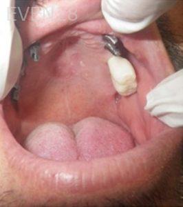 Michael-Shirvani-Full-Mouth-Dental-Implants-after-1