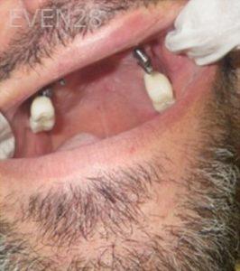 Michael-Shirvani-Full-Mouth-Dental-Implants-after-1b