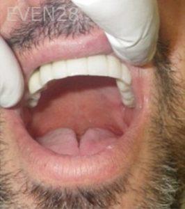 Michael-Shirvani-Full-Mouth-Dental-Implants-after-1c