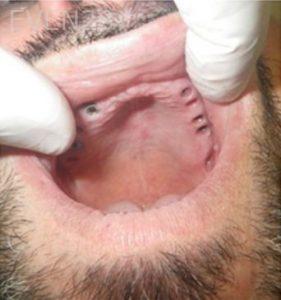 Michael-Shirvani-Full-Mouth-Dental-Implants-before-1