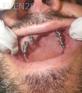 Michael-Shirvani-Full-Mouth-Dental-Implants-before-1b