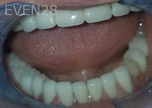 Michael-Shirvani-Full-Mouth-Rehabilitation-after-1