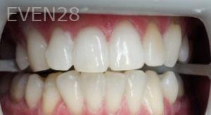 Michael-Shirvani-Teeth-Whitening-after-1