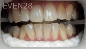 Michael-Shirvani-Teeth-Whitening-before-1