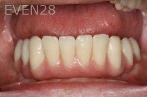 Mike-Choi-All-on-Four-Dental-Implants-after-1