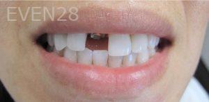 Mimi-Theerathada-Dental-Crowns-before-1