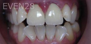 Mimi-Theerathada-Dental-Crowns-before-2