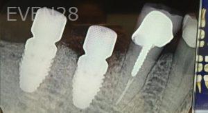 Mimi-Theerathada-Dental-Implants-after-1