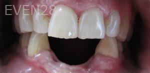 Mimi-Theerathada-Partial-Dentures-before-1