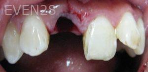 Mimi-Theerathada-Tooth-Transplant-before-1