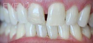 Mojdeh-Shayestehfar-Dental-Bonding-before-1