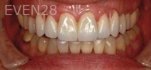 Mojdeh-Shayestehfar-Dental-Implants-after-1