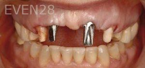 Mojdeh-Shayestehfar-Dental-Implants-before-1