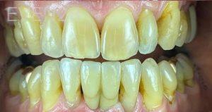 Mufaddal-Kapadia-Dental-Implants-after-1