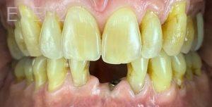 Mufaddal-Kapadia-Dental-Implants-before-1