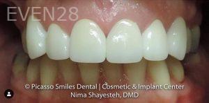 Nima-Shayesteh-Dental-Crowns-after-1