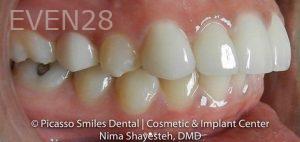Nima-Shayesteh-Dental-Crowns-after-2