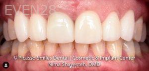 Nima-Shayesteh-Dental-Crowns-after-3