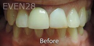Nima-Shayesteh-Dental-Crowns-before-1