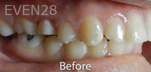 Nima-Shayesteh-Dental-Crowns-before-2