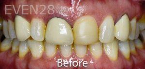 Nima-Shayesteh-Dental-Crowns-before-3