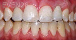 Nima-Shayesteh-Dental-Implants-after-1