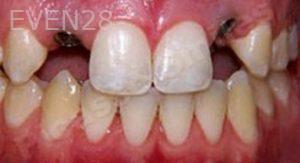 Nima-Shayesteh-Dental-Implants-before-1