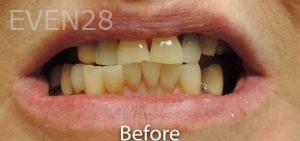 Nima-Shayesteh-Full-Mouth-Rehabilitation-before-1