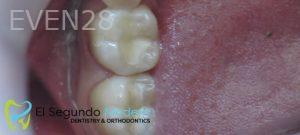 Omid-Barkhordar-Amalgam-Mercury-Removal-after-1