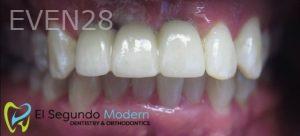 Omid-Barkhordar-Dental-Implants-after-1