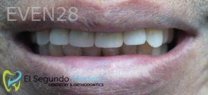 Omid-Barkhordar-Dental-Implants-after-2