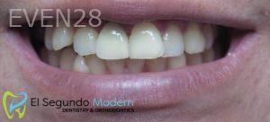 Omid-Barkhordar-Dental-Implants-after-3