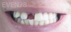 Omid-Barkhordar-Dental-Implants-before-3