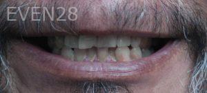 Omid-Barkhordar-Porcelain-Veneers-before-2