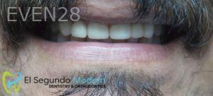 Omid-Barkhordar-Smile-Makeover-after-1