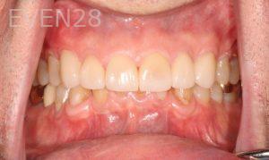Peter-Suh-Dental-Crowns-after-2