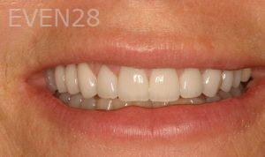 Peter-Suh-Dental-Crowns-after-3