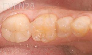 Peter-Suh-Dental-Crowns-after-5